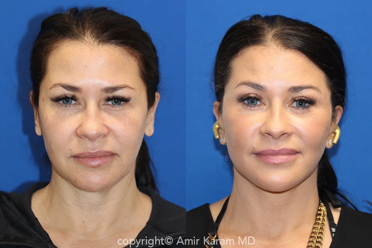 Vertical Restore® / Facial Rejuvenation Before & After Gallery - Patient 71700661 - Image 1