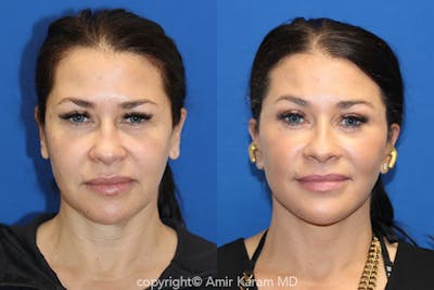 Vertical Restore® / Facial Rejuvenation Before & After Gallery - Patient 71700661 - Image 1