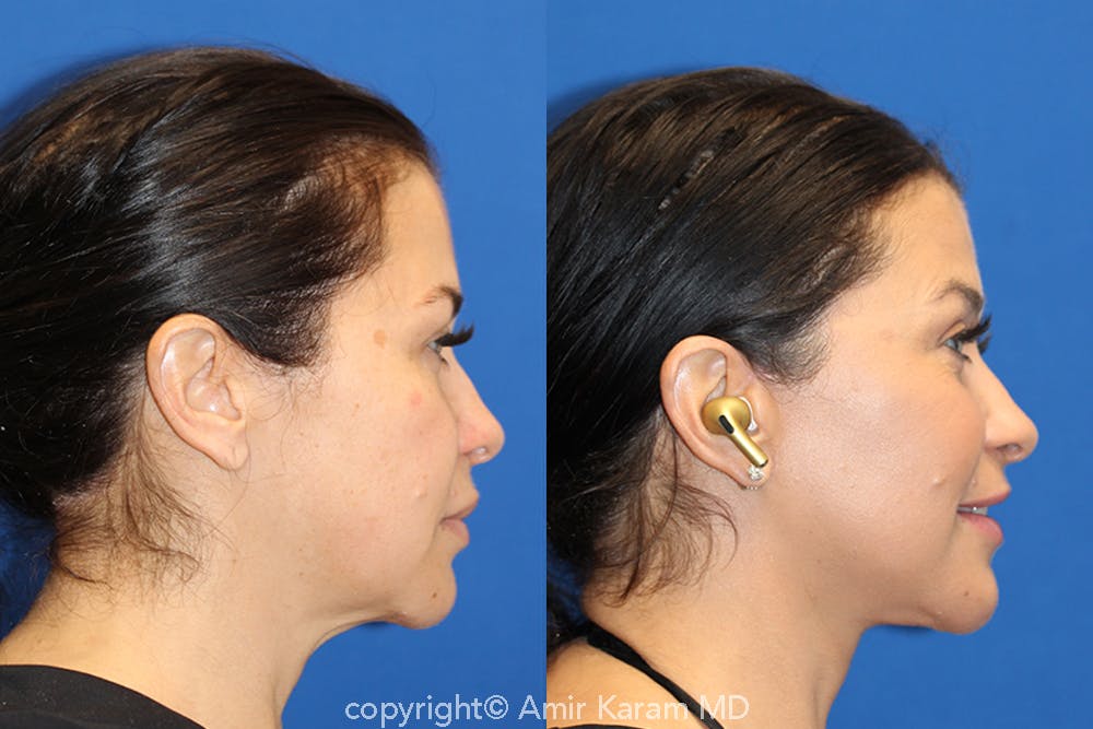 Vertical Restore® / Facial Rejuvenation Before & After Gallery - Patient 71700661 - Image 2