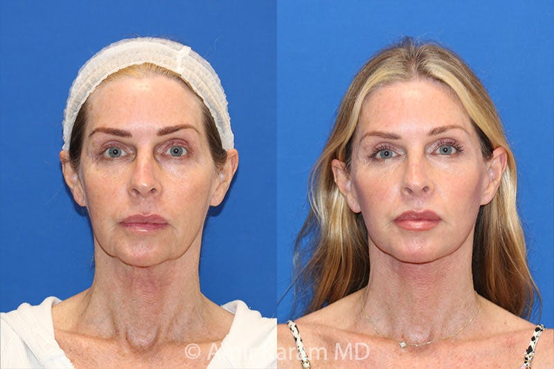 Lip Lift Before & After Gallery - Patient 71700664 - Image 1