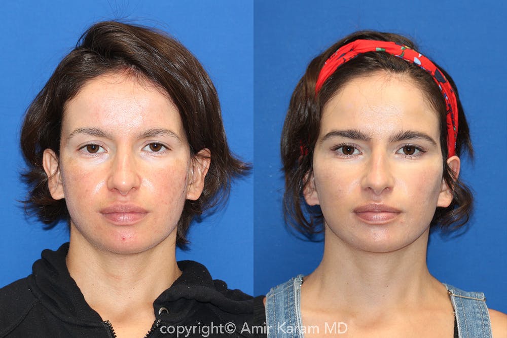 Vertical Restore® / Facial Rejuvenation Before & After Gallery - Patient 71700665 - Image 1