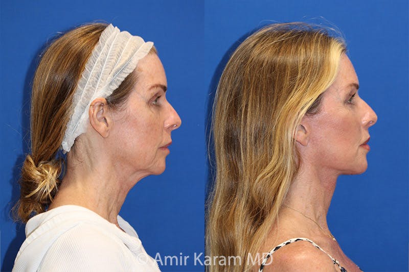 Lip Lift Before & After Gallery - Patient 71700664 - Image 2