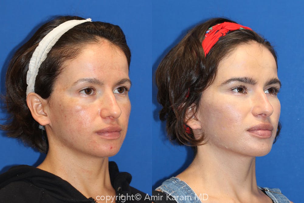Vertical Restore® / Facial Rejuvenation Before & After Gallery - Patient 71700665 - Image 2