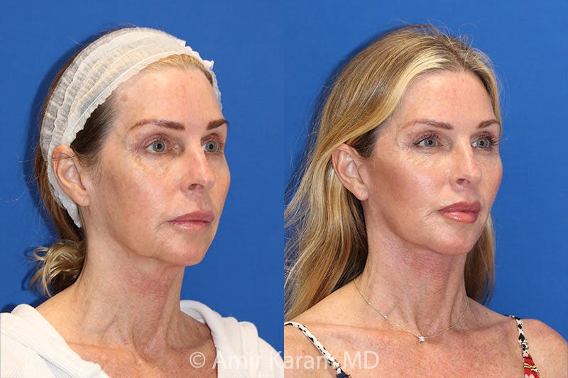 Lip Lift Before & After Gallery - Patient 71700664 - Image 3