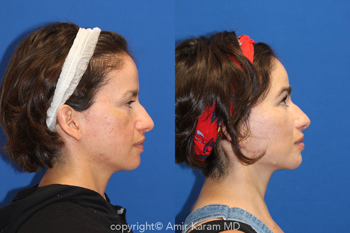 Vertical Restore® / Facial Rejuvenation Before & After Gallery - Patient 71700665 - Image 3
