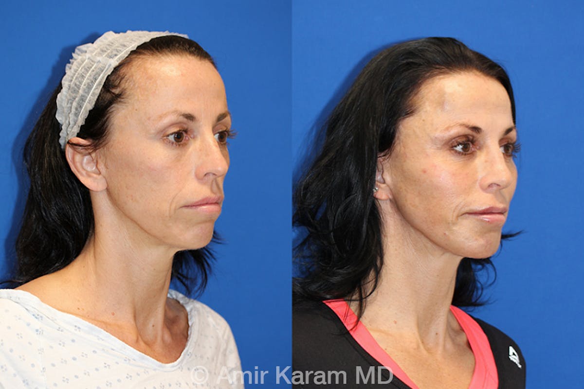 Fat Transfer Before & After Gallery - Patient 71700669 - Image 2
