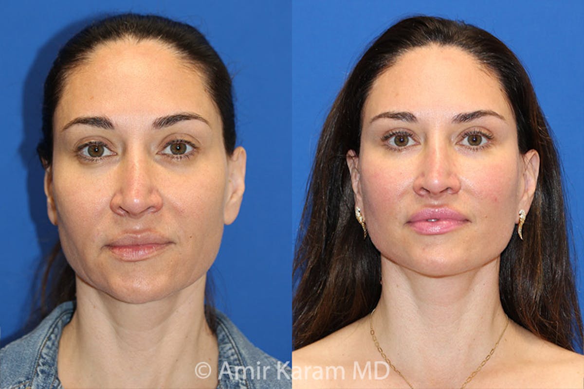 Lip Lift Before & After Gallery - Patient 71700666 - Image 1