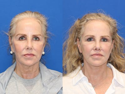 Vertical Restore® / Facial Rejuvenation Before & After Gallery - Patient 71700670 - Image 1