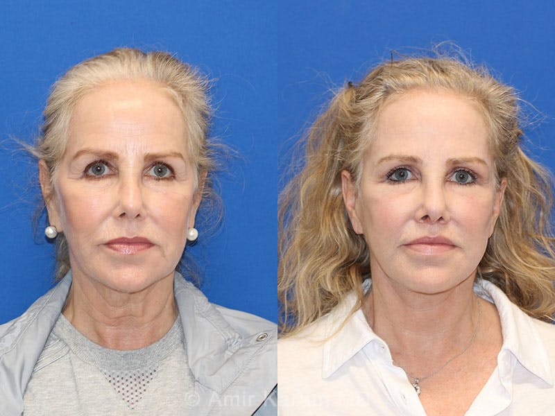 Vertical Restore® / Facial Rejuvenation Before & After Gallery - Patient 71700670 - Image 1