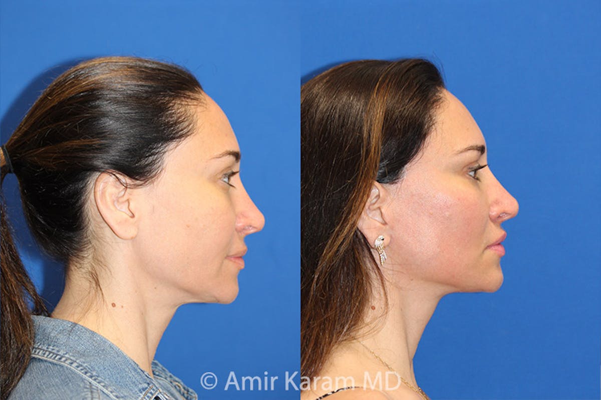 Lip Lift Before & After Gallery - Patient 71700666 - Image 2
