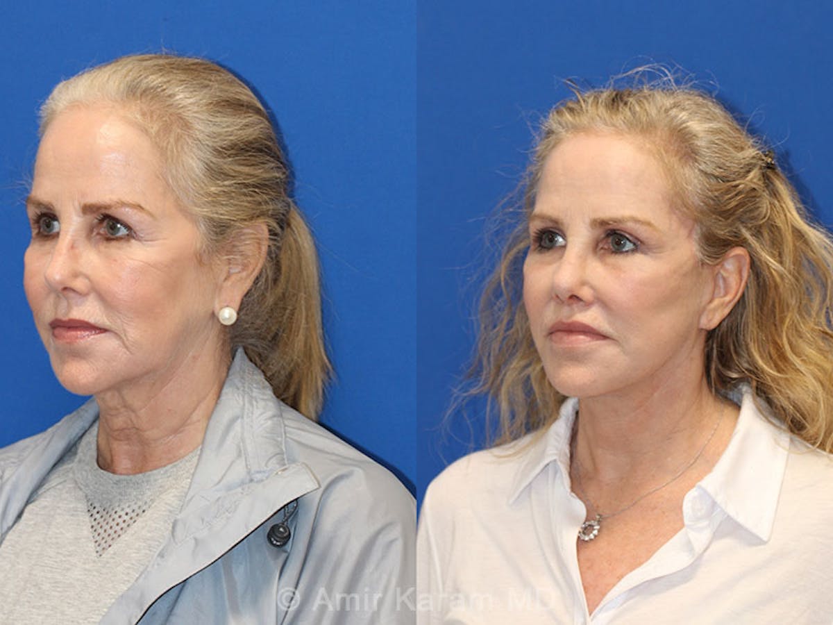Vertical Restore® / Facial Rejuvenation Before & After Gallery - Patient 71700670 - Image 2