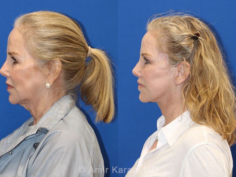 Vertical Restore® / Facial Rejuvenation Before & After Gallery - Patient 71700670 - Image 3
