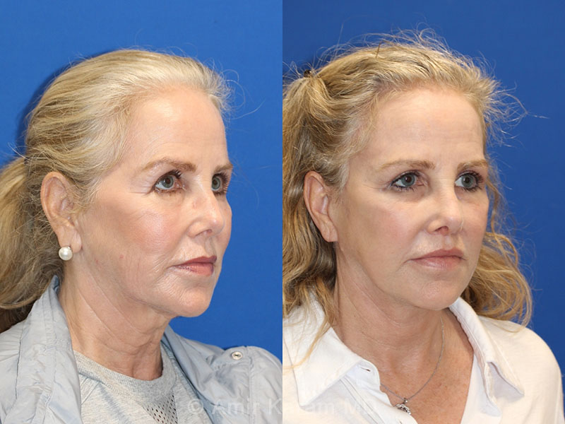 Patient 71700670 Vertical Restore® / Facial Rejuvenation Before