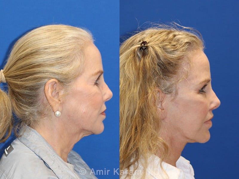 Vertical Restore® / Facial Rejuvenation Before & After Gallery - Patient 71700670 - Image 5