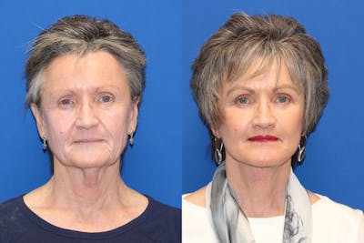 Vertical Restore® / Facial Rejuvenation Before & After Gallery - Patient 71700690 - Image 1