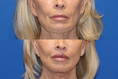Lip Lift Before & After Gallery - Patient 71700680 - Image 1