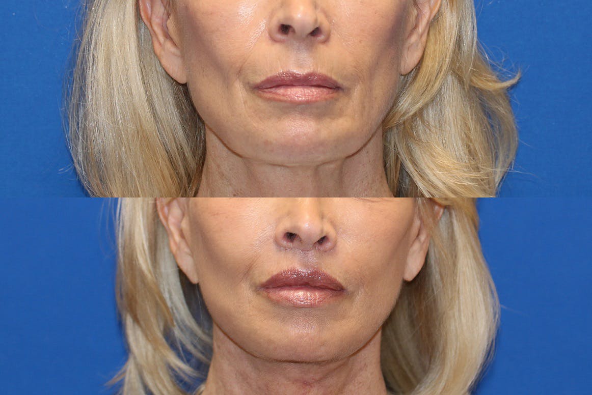 Lip Lift Before & After Gallery - Patient 71700680 - Image 1