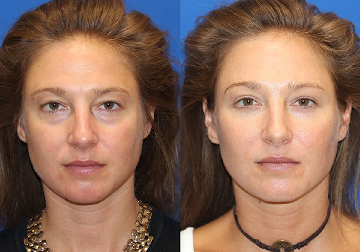 Fat Transfer Before & After Gallery - Patient 71700682 - Image 1