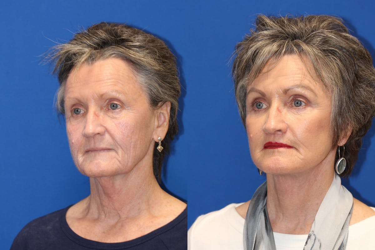 Vertical Restore® / Facial Rejuvenation Before & After Gallery - Patient 71700690 - Image 2