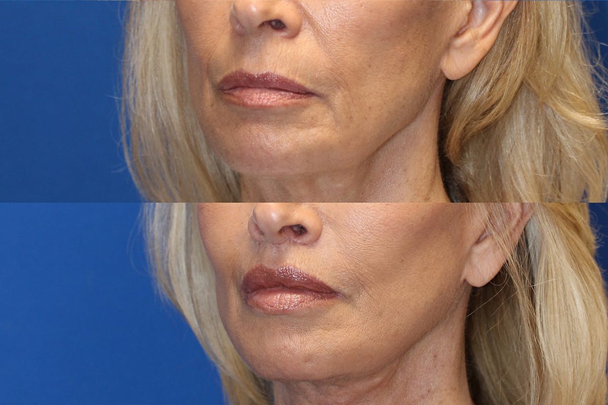 Lip Lift Before & After Gallery - Patient 71700680 - Image 2