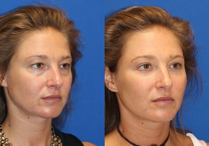 Fat Transfer Before & After Gallery - Patient 71700682 - Image 2