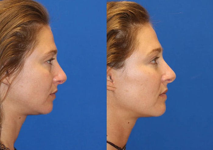 Fat Transfer Before & After Gallery - Patient 71700682 - Image 3