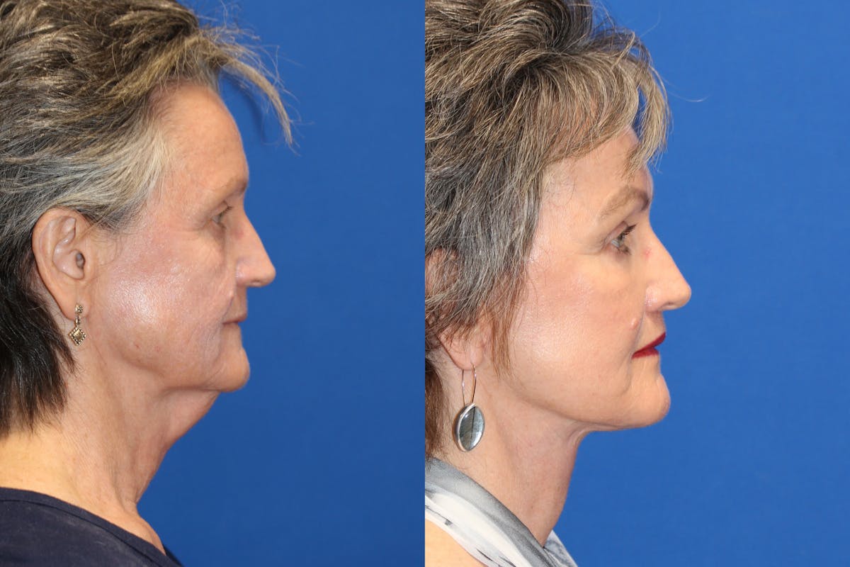 Fat Transfer Before & After Gallery - Patient 91507319 - Image 3
