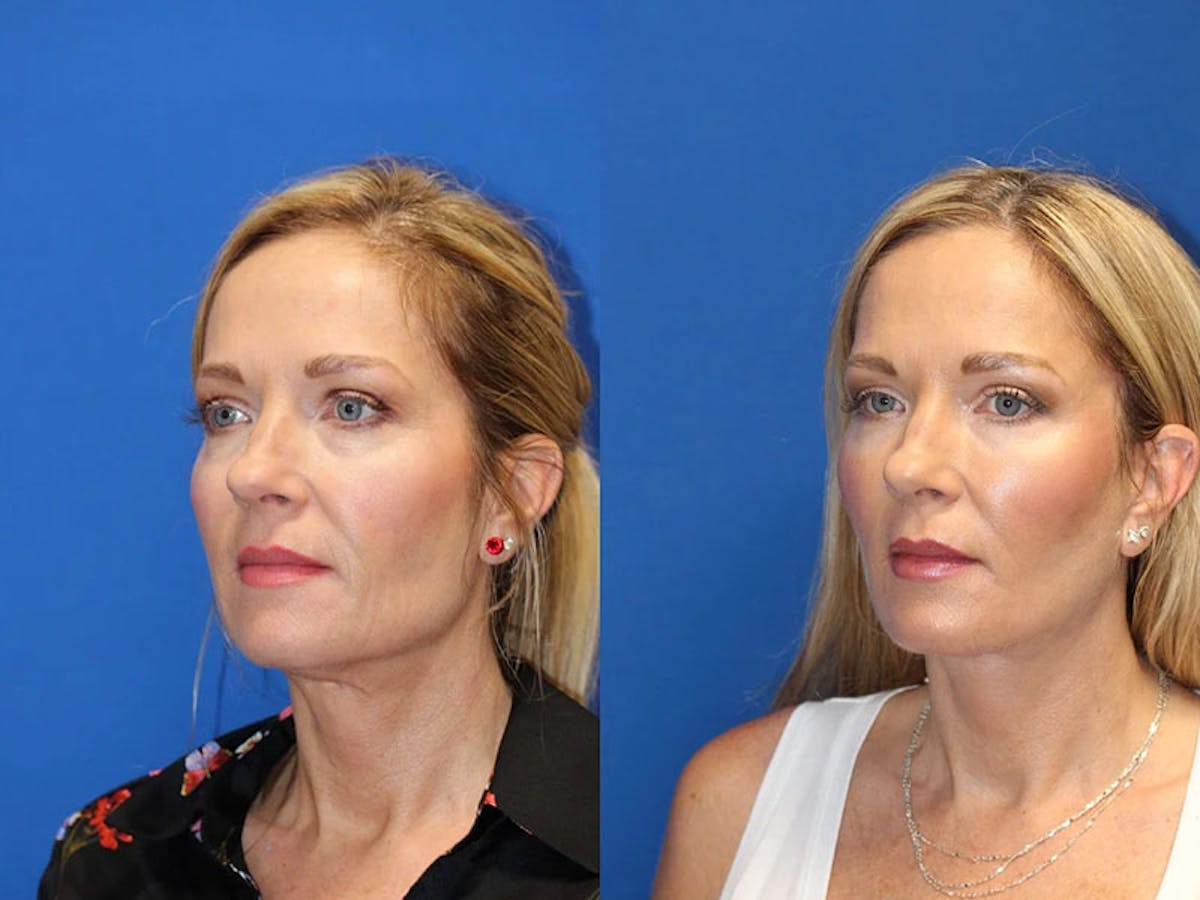 Fat Transfer Before & After Gallery - Patient 71700689 - Image 2