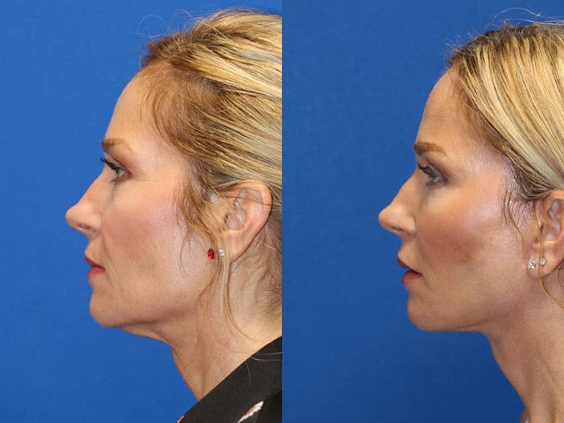 Fat Transfer Before & After Gallery - Patient 71700689 - Image 3