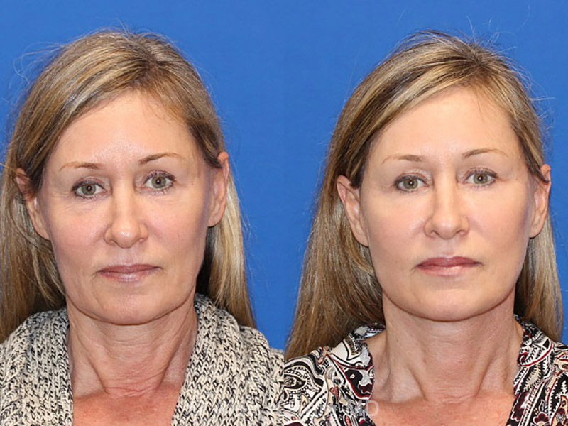 Patient 71700697 Vertical Restore® / Facial Rejuvenation Before & After Photos Carmel Valley