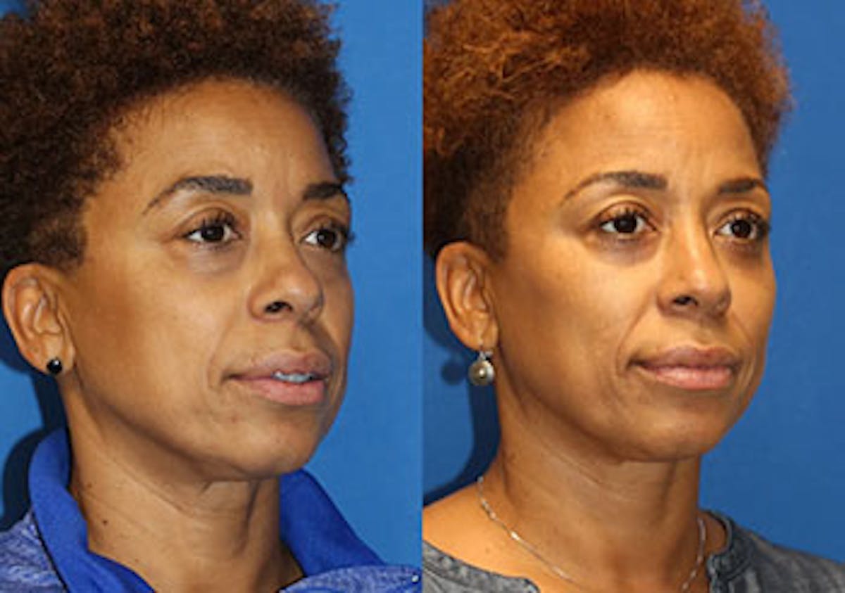 Fat Transfer Before & After Gallery - Patient 71700693 - Image 2