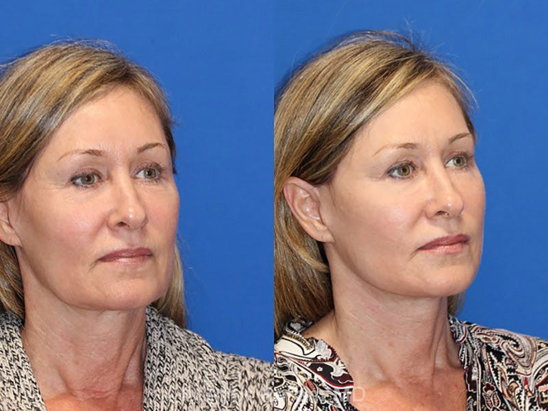 Fat Transfer Before & After Gallery - Patient 91514593 - Image 2