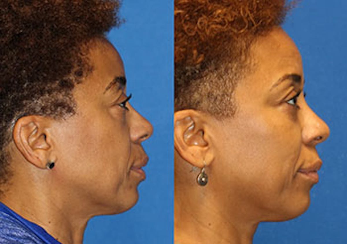 Fat Transfer Before & After Gallery - Patient 71700693 - Image 3