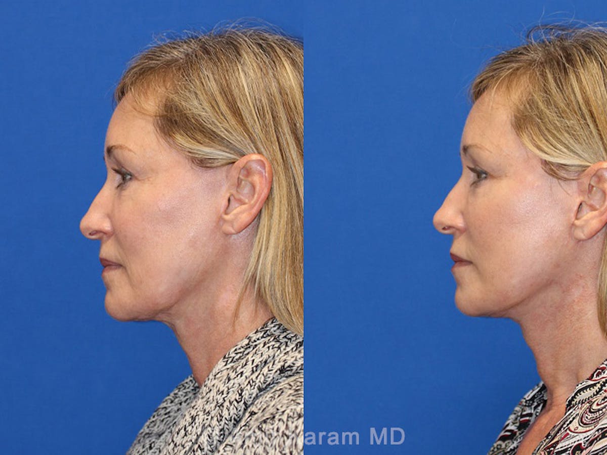 Vertical Restore® / Facial Rejuvenation Before & After Gallery - Patient 71700697 - Image 3