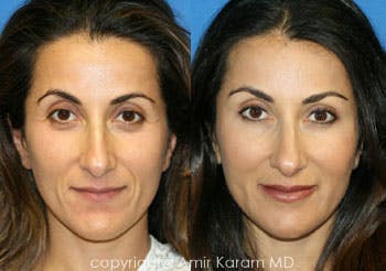 Fat Transfer Before & After Gallery - Patient 71700695 - Image 1