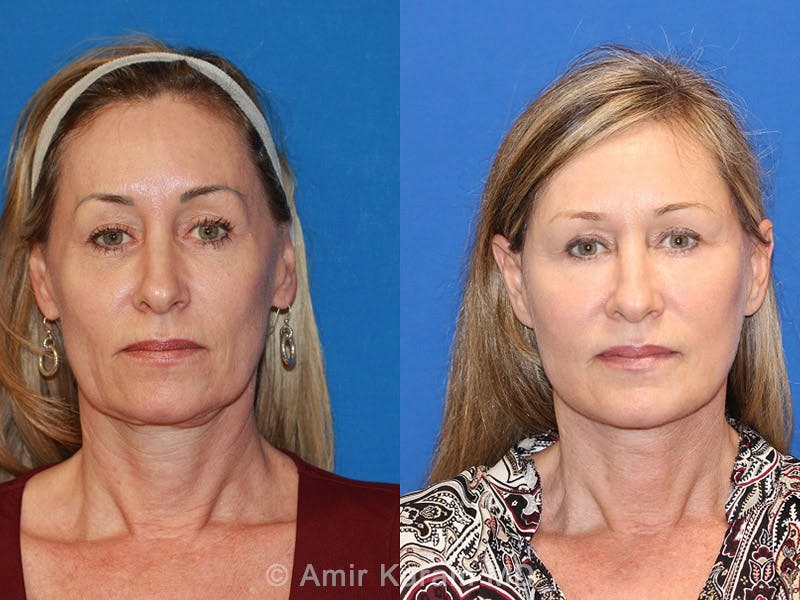 Vertical Restore® / Facial Rejuvenation Before & After Gallery - Patient 71700697 - Image 4