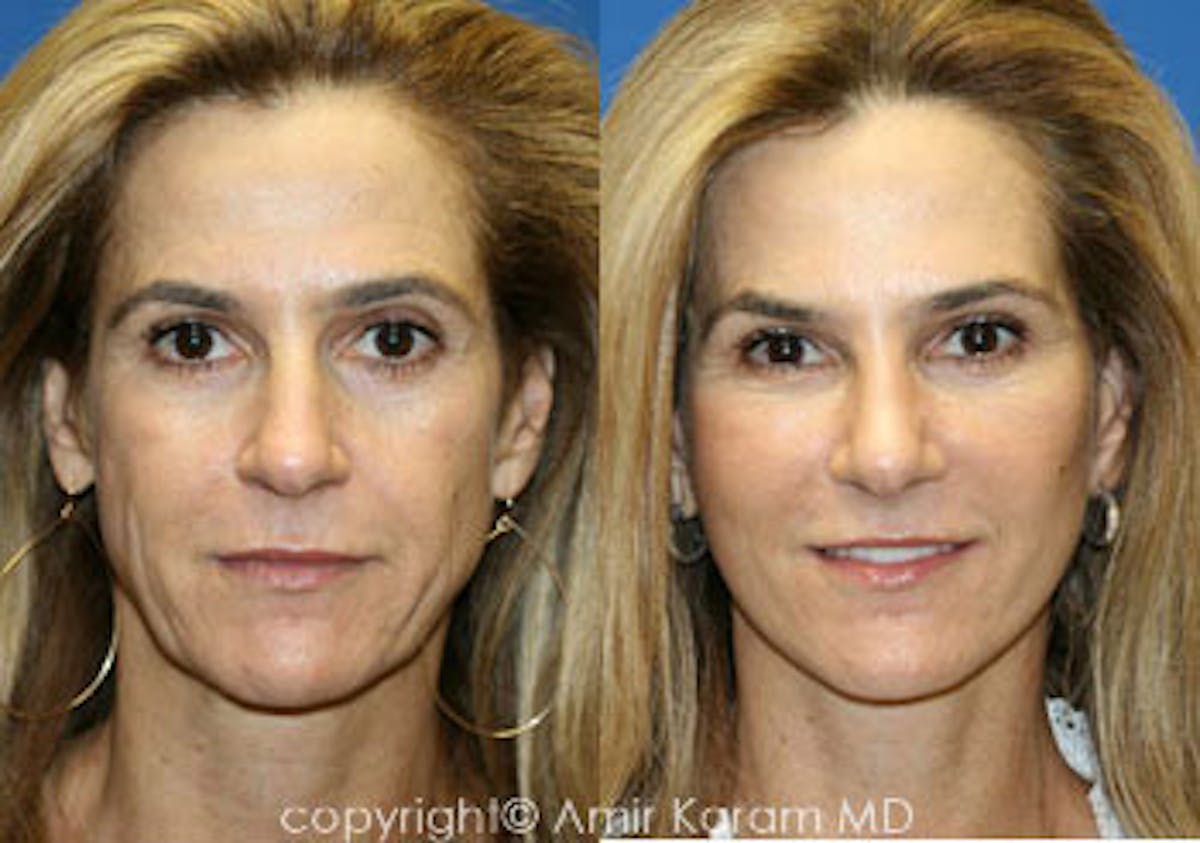 Vertical Restore® / Facial Rejuvenation Before & After Gallery - Patient 71700701 - Image 1