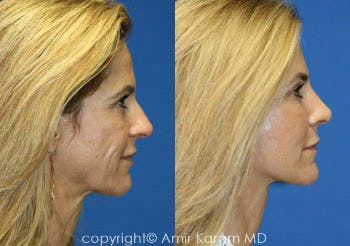 Vertical Restore® / Facial Rejuvenation Before & After Gallery - Patient 71700701 - Image 2