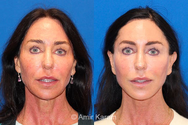 Vertical Restore® / Facial Rejuvenation Before & After Gallery - Patient 71700709 - Image 1