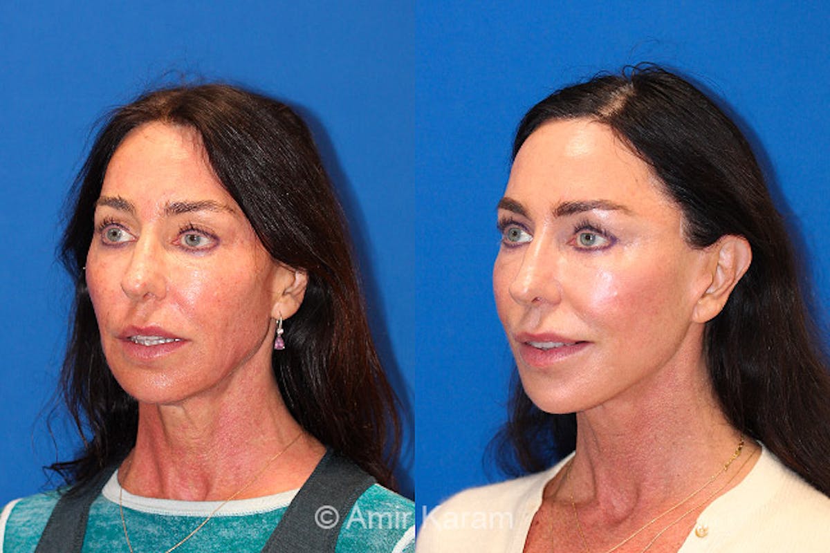 Vertical Restore® / Facial Rejuvenation Before & After Gallery - Patient 71700709 - Image 2