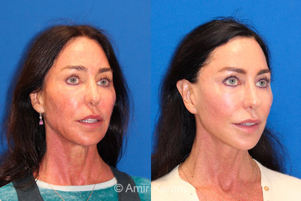 Vertical Restore® / Facial Rejuvenation Before & After Gallery - Patient 71700709 - Image 3