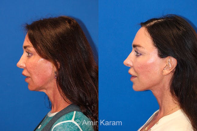 Vertical Restore® / Facial Rejuvenation Before & After Gallery - Patient 71700709 - Image 4