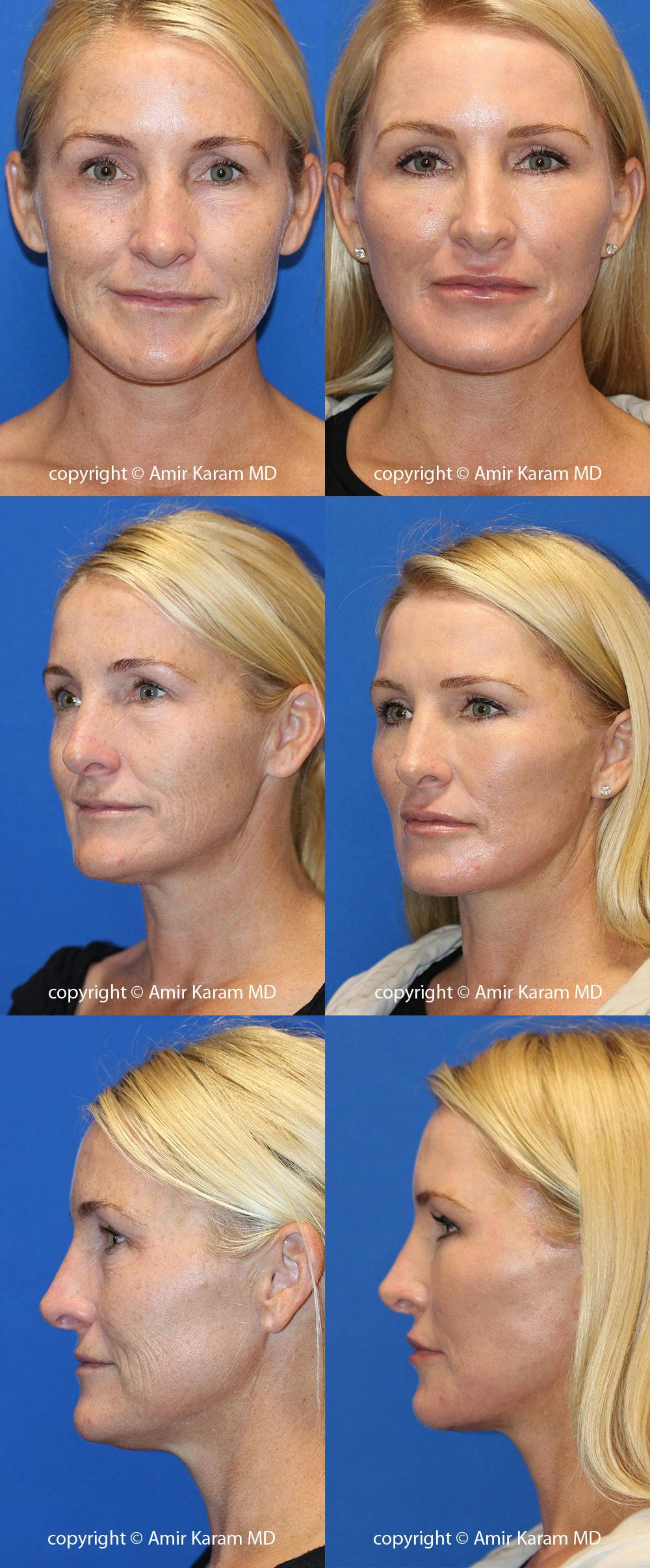 Vertical Restore® / Facial Rejuvenation Before & After Gallery - Patient 71700712 - Image 1