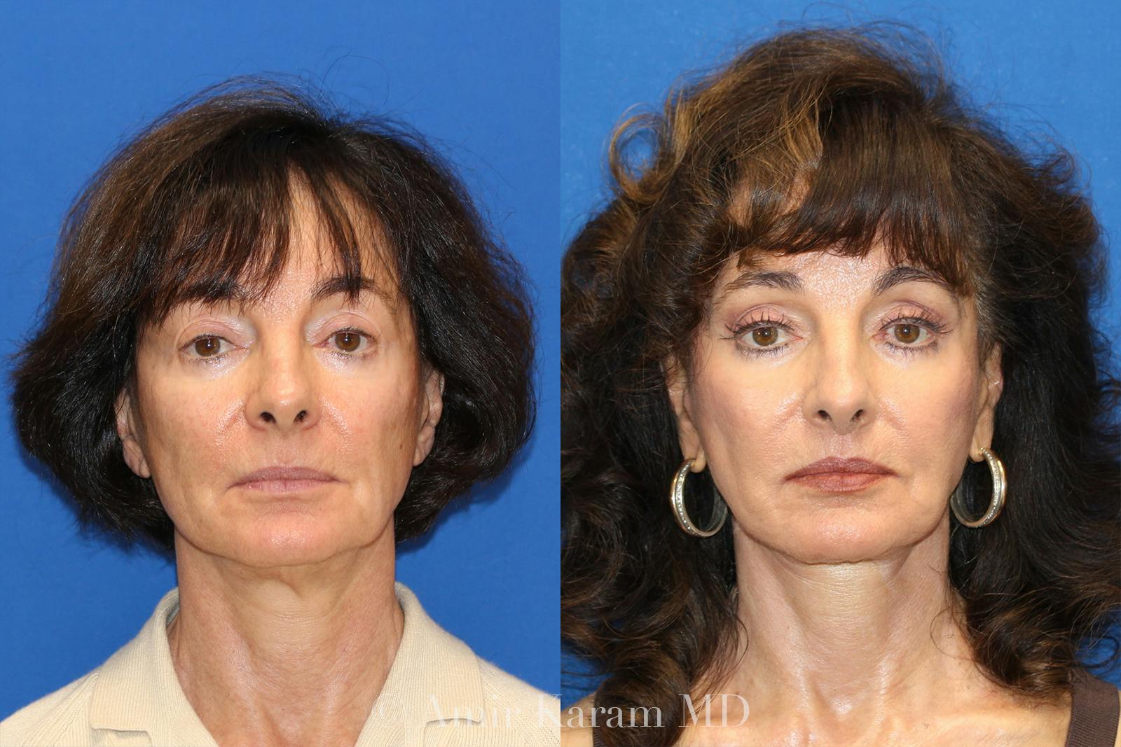 Vertical Restore® / Facial Rejuvenation Before & After Gallery - Patient 71700718 - Image 1