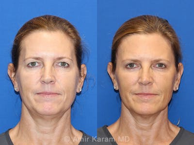 Fat Transfer Before & After Gallery - Patient 71700741 - Image 1