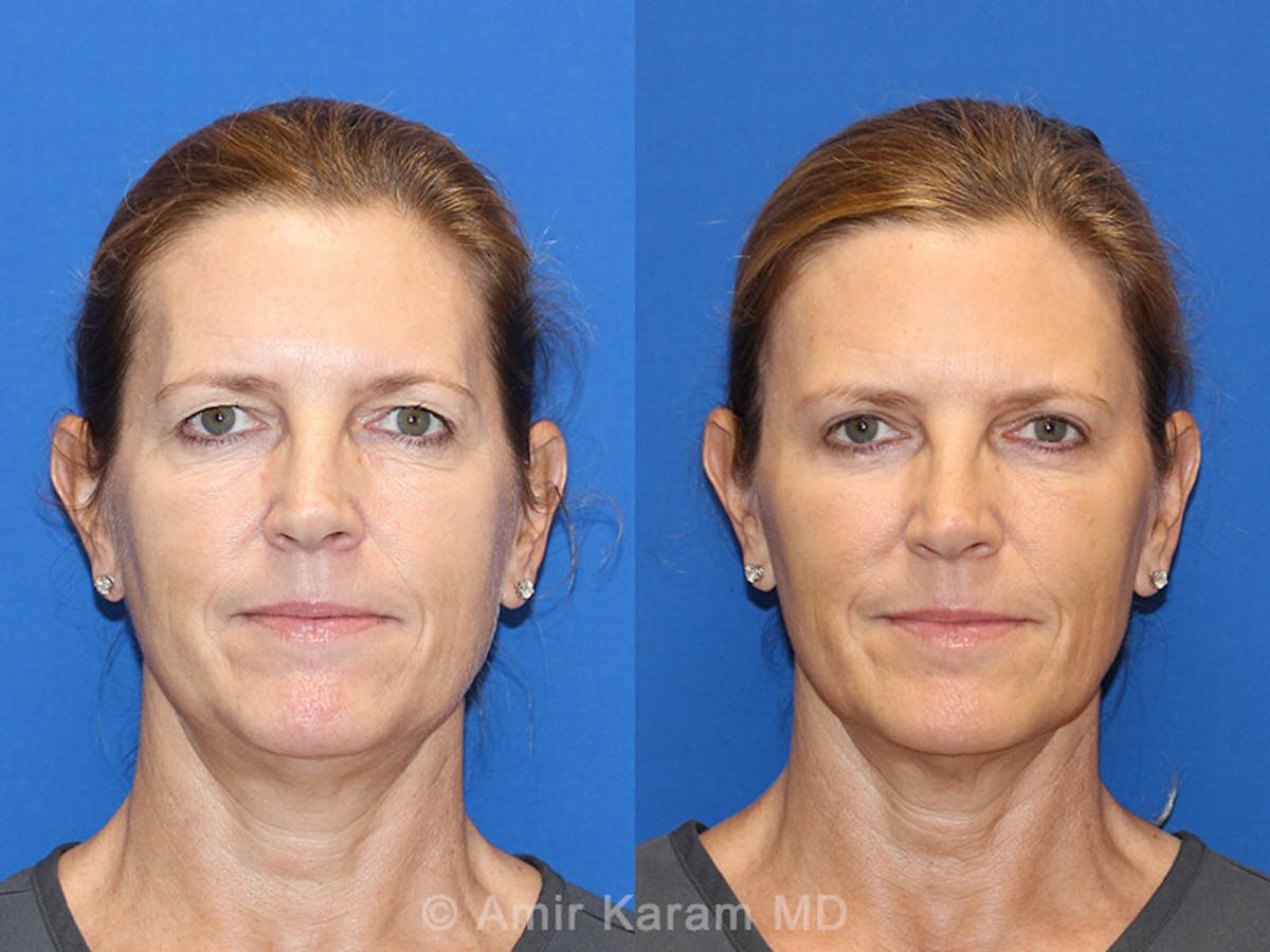 Fat Transfer Before & After Gallery - Patient 71700741 - Image 1