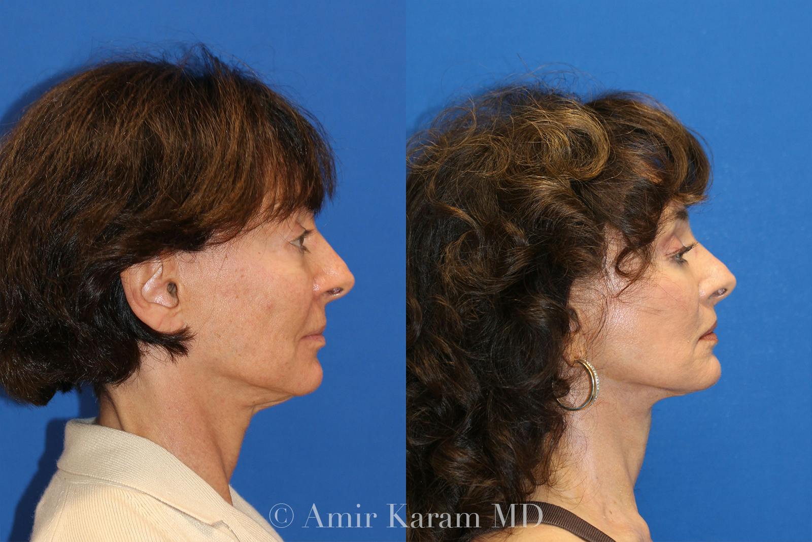 Vertical Restore® / Facial Rejuvenation Before & After Gallery - Patient 71700718 - Image 2