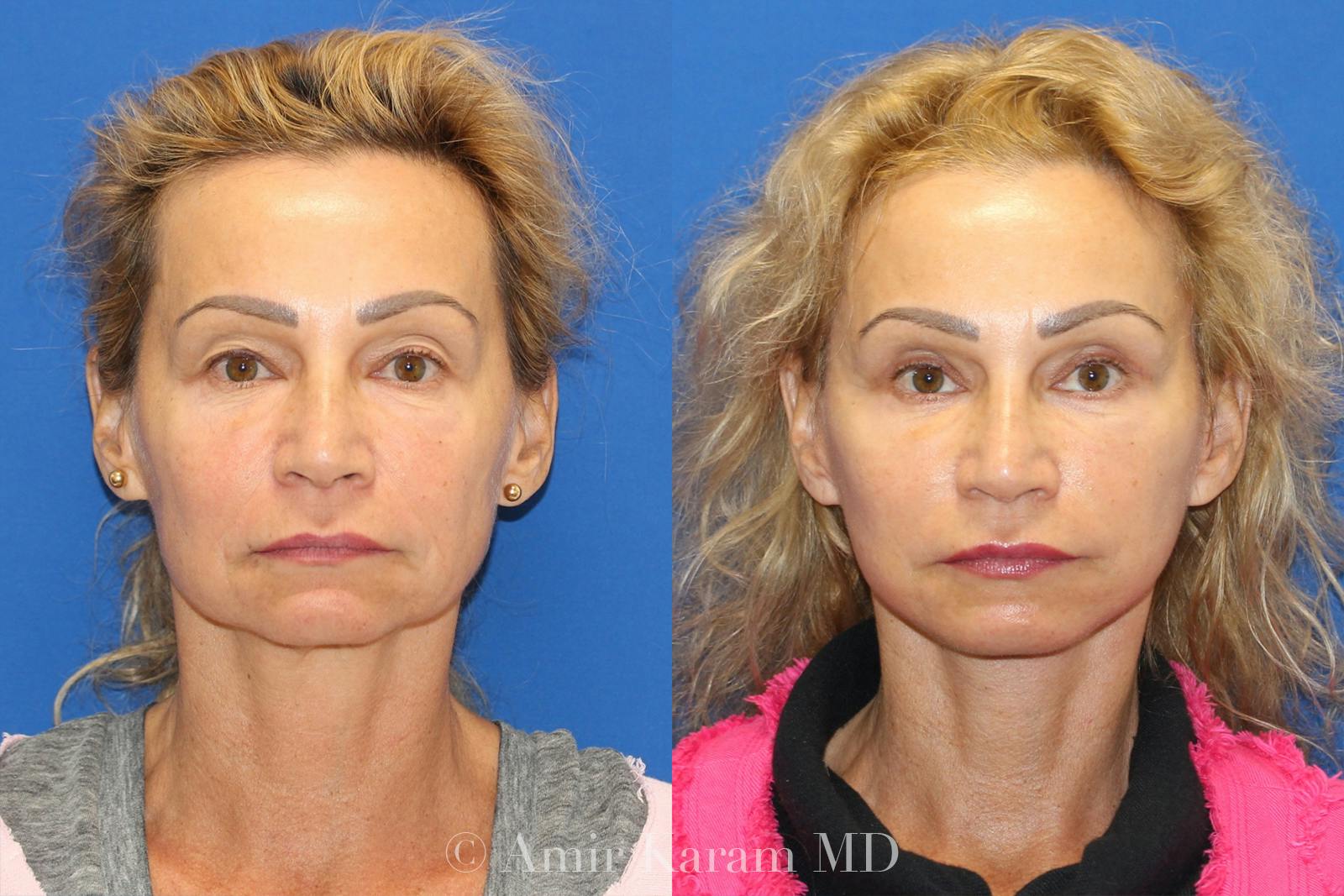 Vertical Restore® / Facial Rejuvenation Before & After Gallery - Patient 71700736 - Image 1