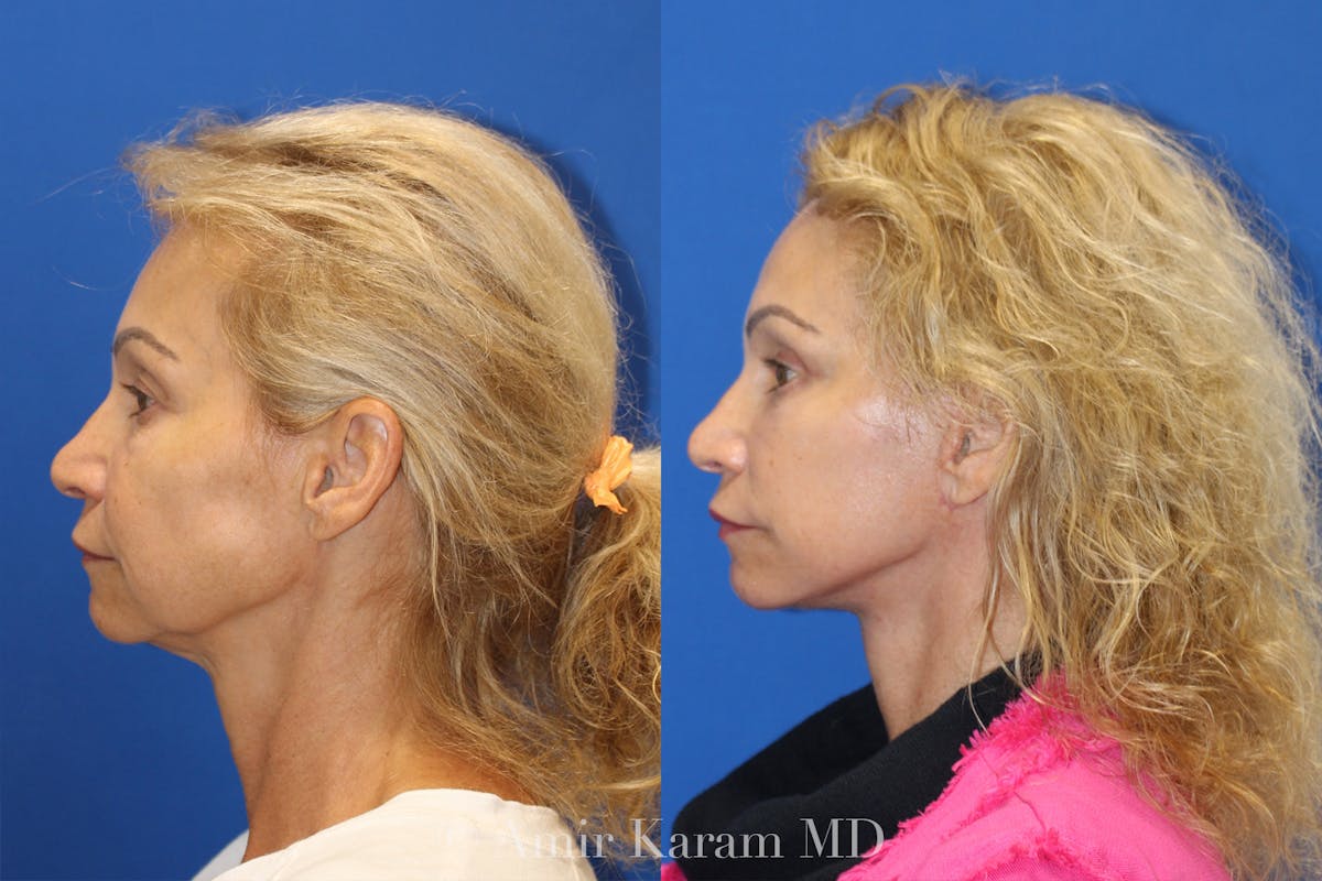 Vertical Restore® / Facial Rejuvenation Before & After Gallery - Patient 71700736 - Image 2