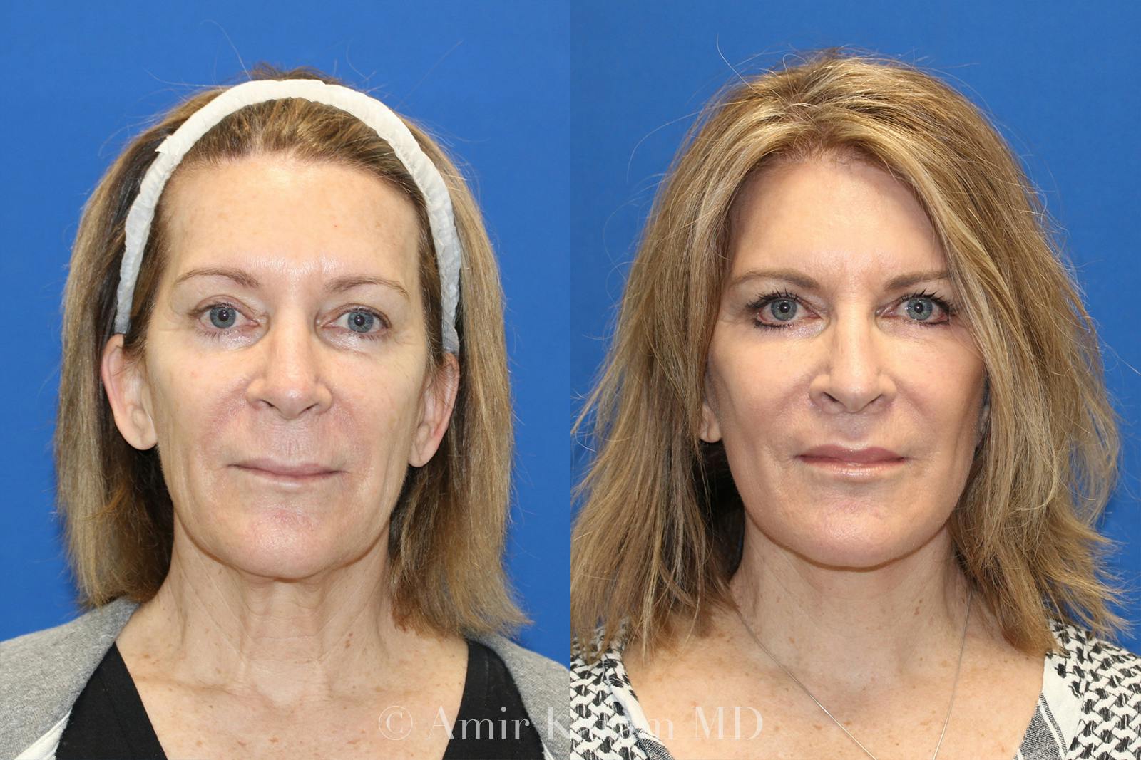 Vertical Restore® / Facial Rejuvenation Before & After Gallery - Patient 71700742 - Image 1